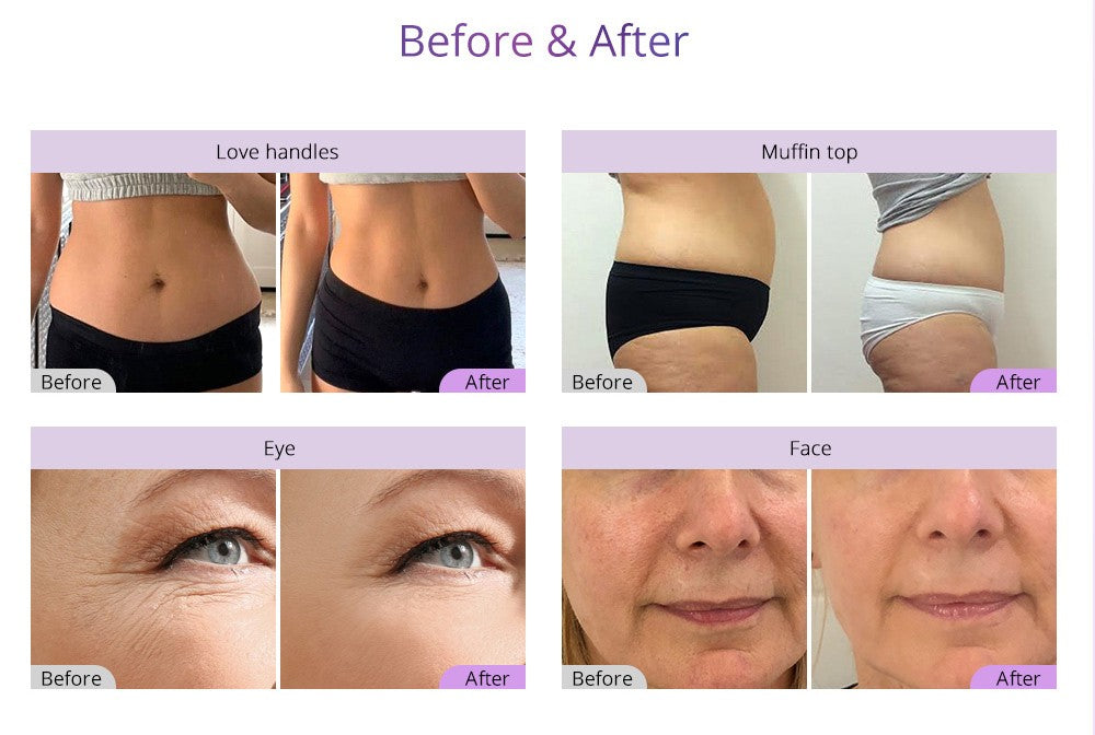9 In 1 RF with Ultrasonic 40K Cavitation 2.5 with Lipo Laser image 5