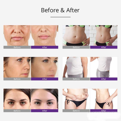 5 in 1 Ultrasonic 30K Cavitation Radio Frequency RF with EMS &amp; EL (Electric Muscle Stimulation and Electroporation) S-Shape Machine image 4